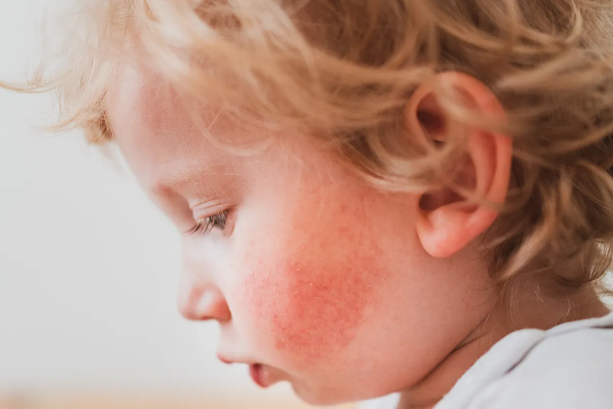 Votre enfant à de l'eczema, Guide pratique par la maison de santé Caducée